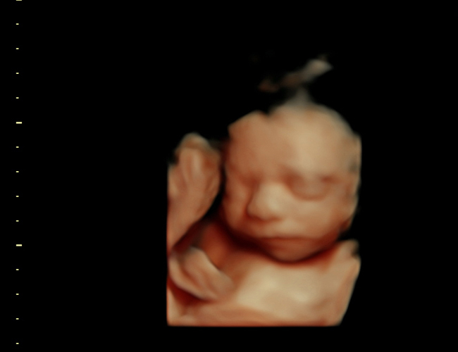 3D ultrasound image at 25 weeks
